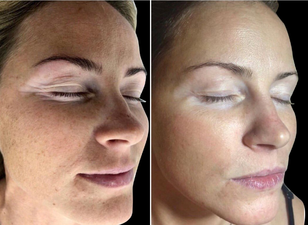 HydroVerstand after five treatments visual at Science of Beauty Annapolis