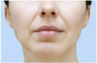 Before V-Line Lift Facial treatment